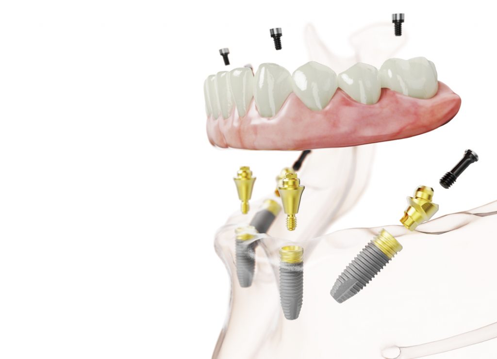 Nobel Biocare All-on-4 fogászati implantáció