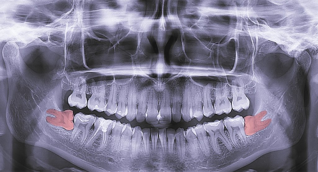 Bölcsességfog beszorulása röntgenen